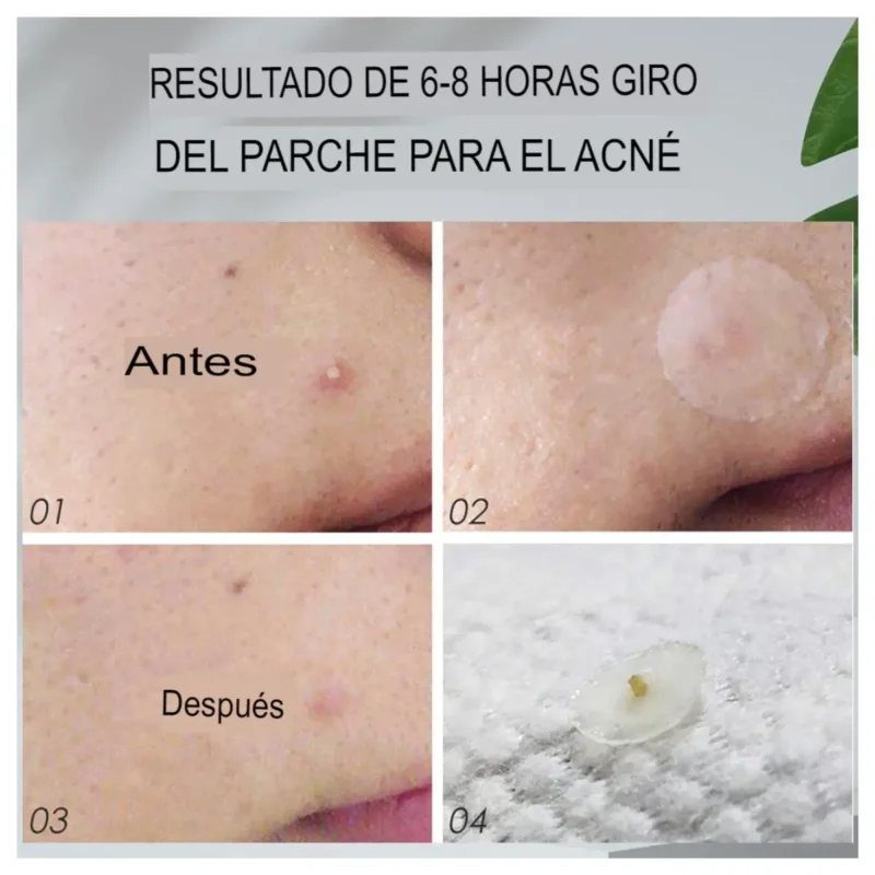 Parches Médicos para Acné 120 Piezas - Imagen 3