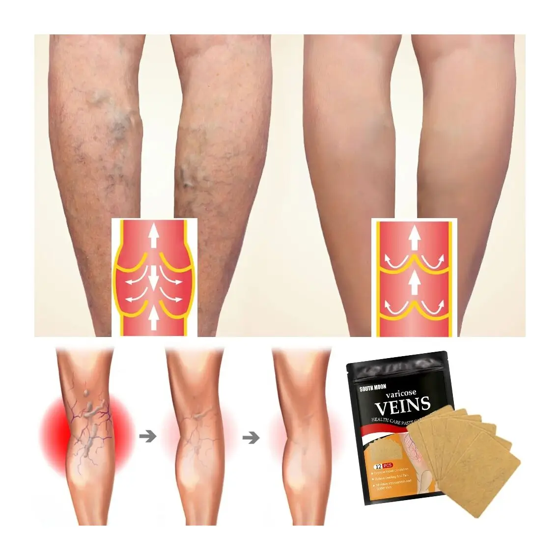 Parches para Várices - Imagen 3